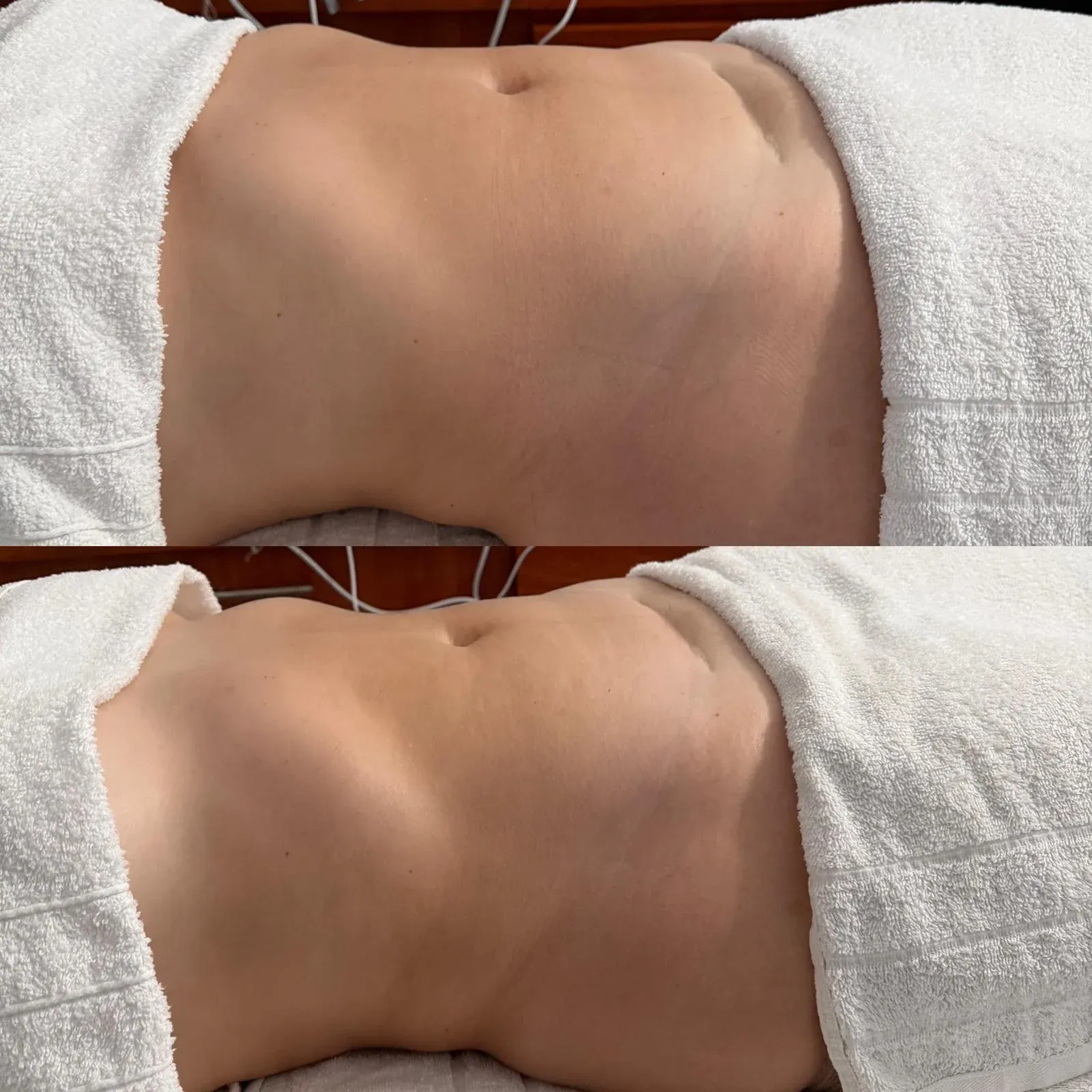 Antes y después de un tratamiento corporal en el abdomen