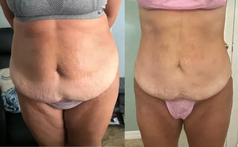 Antes y después de un tratamiento de contorno corporal en abdomen y piernas