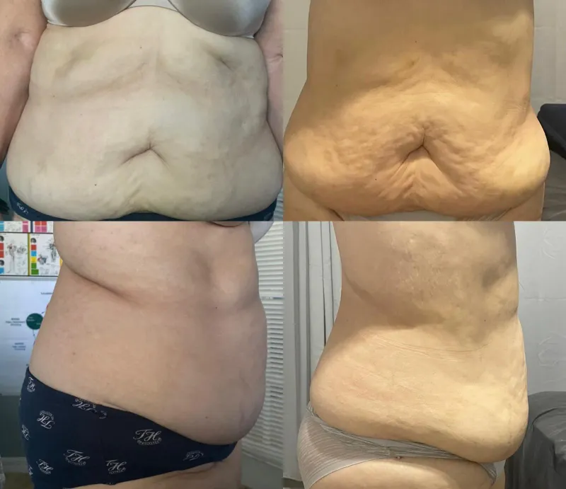 Antes y después de un tratamiento corporal en el abdomen, vista frontal y lateral