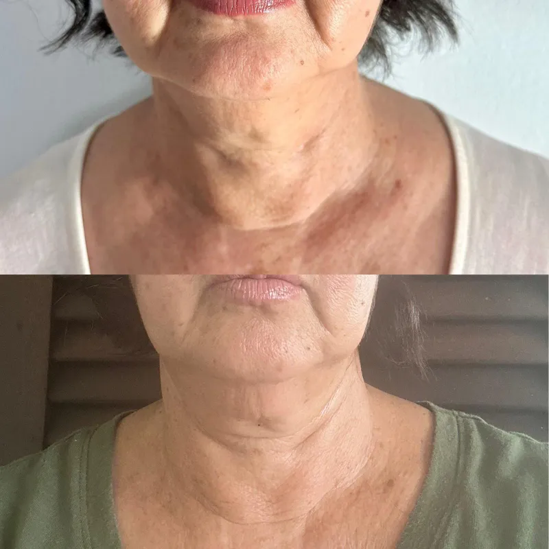 Antes y después de un tratamiento de rejuvenecimiento de la piel del cuello