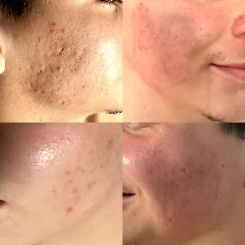Antes y después de un tratamiento facial para el acné en la mejilla
